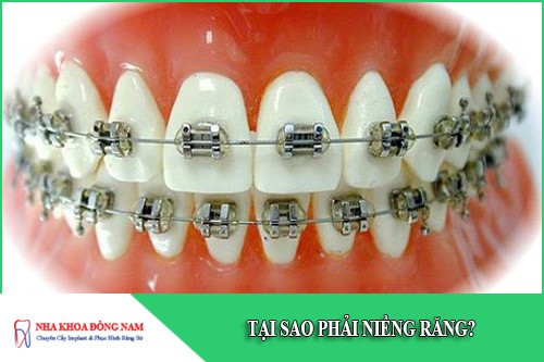tại sao phải niềng răng
