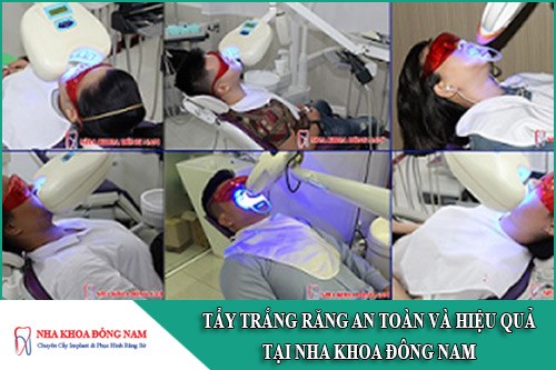 tẩy trắng răng an toàn và hiệu quả tại nha khoa đông nam