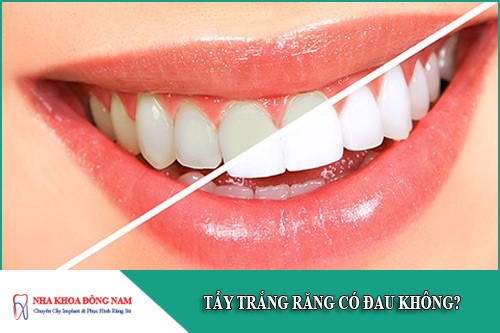tẩy trắng răng có đau không