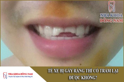 té xe bị gãy răng thì có trám được không