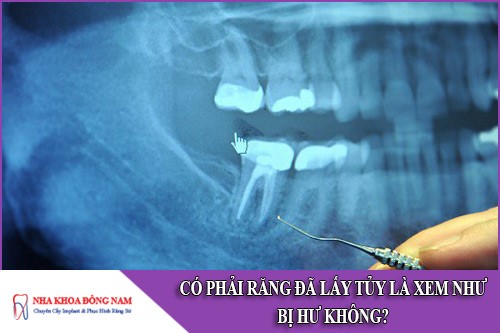 có phải răng đã lấy tủy là xem như bị hư không