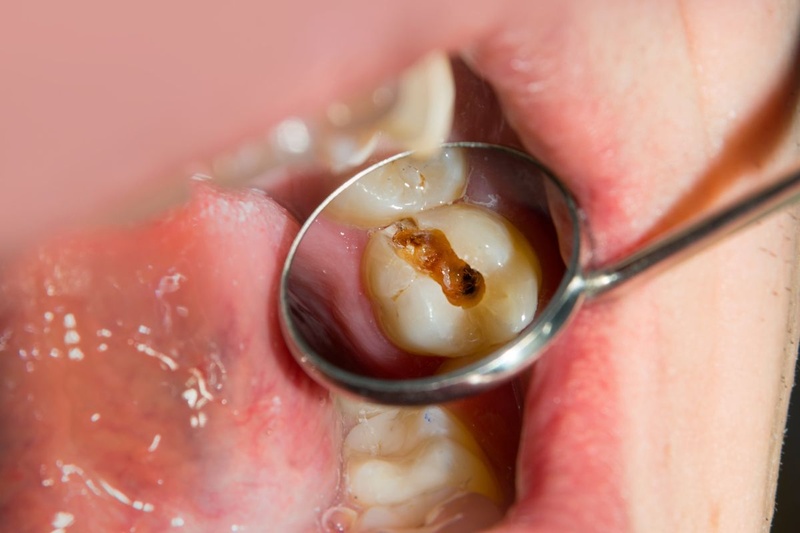 Tiêu chí chỉ định để bọc sứ răng sâu