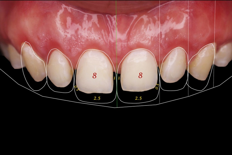 Tiêu chuẩn hình thể răng đẹp theo quan điểm chuyên môn