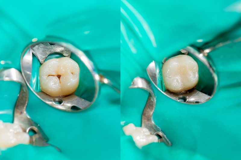 Trám răng sâu phòng ngừa vi khuẩn xâm nhập