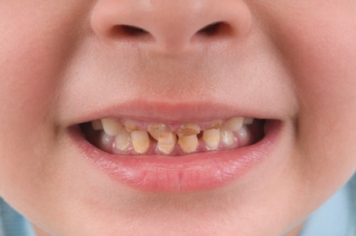 trẻ em có nên tẩy trắng răng không 1