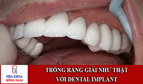 trồng răng giả như thật với implant nha khoa 1