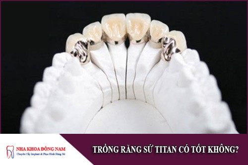 trồng răng sứ titan có tốt không