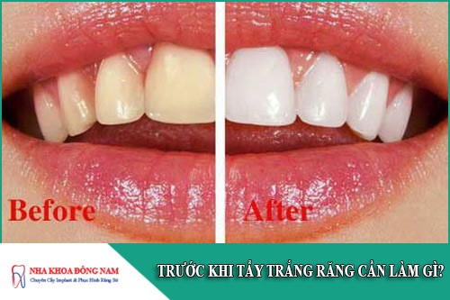 trước khi tẩy trắng răng cần làm gì