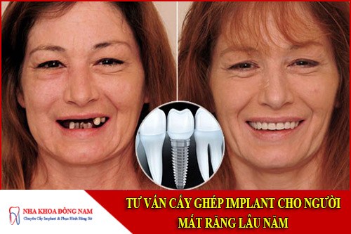 Tư Vấn Cấy Ghép Implant Cho Người Mất Răng Lâu Năm