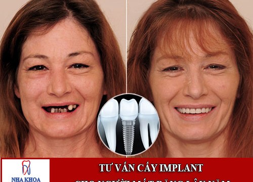 tư vấn cấy ghép implant cho người mất răng lâu năm