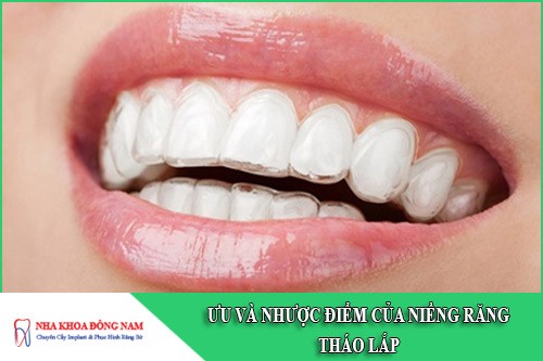 ưu và nhược điểm của niềng răng tháo lắp