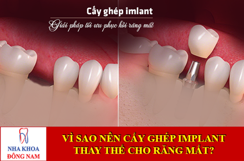 Vì sao nên cấy ghép implant thay thế cho răng mất?