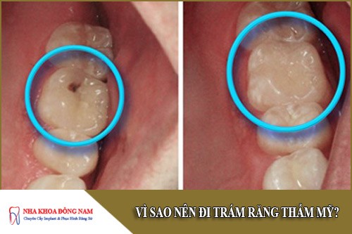 vì sao nên đi trám răng thẩm mỹ
