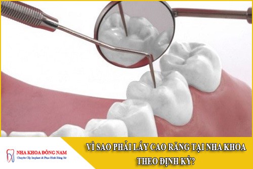 vì sao phải lấy cao răng tại nha khoa theo định kỳ