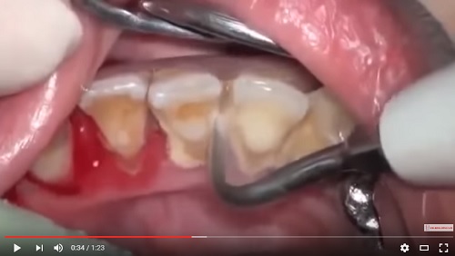 video cận cảnh cạo vôi răng để lâu ngày