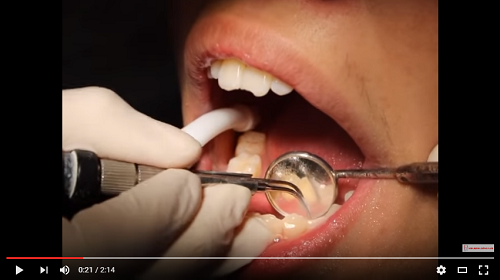 video cạo vôi răng tại nha khoa đông nam