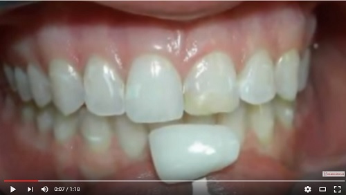 video hình ảnh sau khi dán laminate sứ cho răng