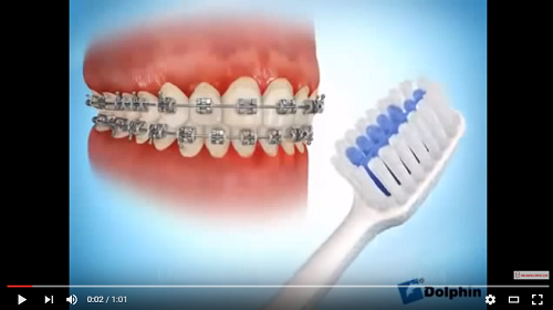 video hướng dẫn đánh răng sau khi niềng răng