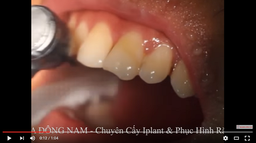 video mài răng bị mẻ cho đều nhau tại nha khoa