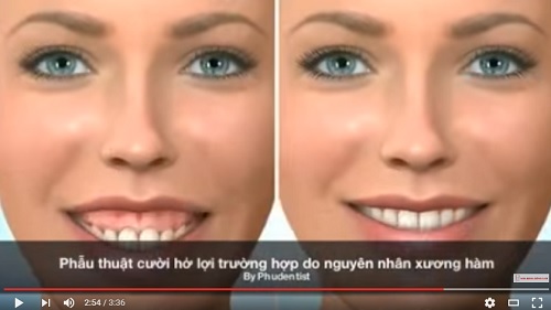 video mô phỏng cách thức điều trị cười hở lợi