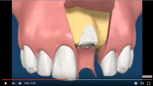 video mô phỏng cấy ghép xương trong implant