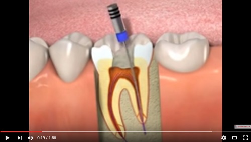 video mô phỏng quá trình chữa tủy răng đúng chuẩn