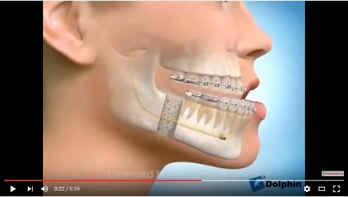 video mô phỏng quá trình phẫu thuật hàm móm