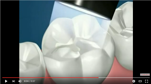 video mô phỏng quá trình trám răng sâu