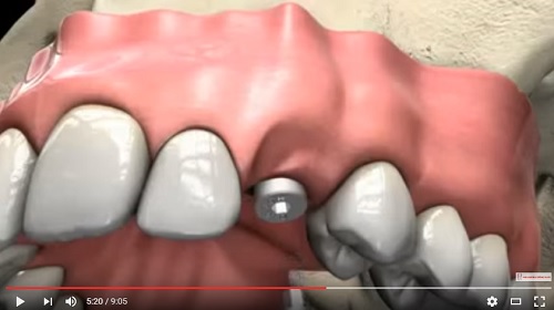 video quá trình cắm ghép implant hàm trên