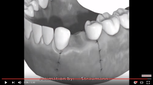 video quá trình cấy ghép implant vào răng hàm dưới