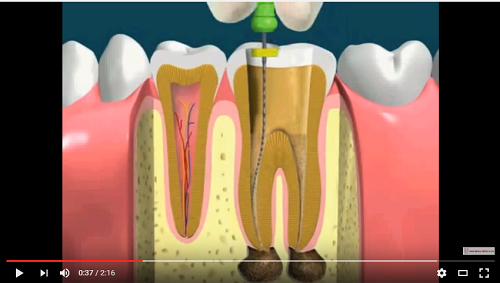 video quá trình chữa tủy răng bị nhiễm trùng