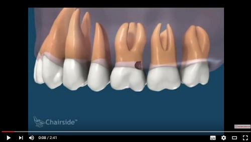 video qúa trình điều trị sâu chân răng và răng bị bể