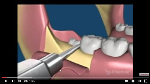 video quá trình nhổ các loại răng khôn