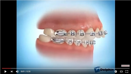 video quá trình niềng răng hô hiệu quả