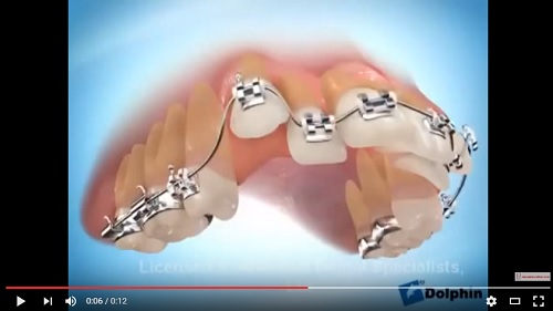 video quá trình niềng răng khểnh cho đều