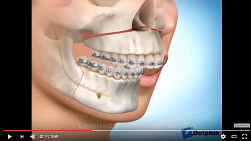 video quá trình phẫu thuật hàm hô