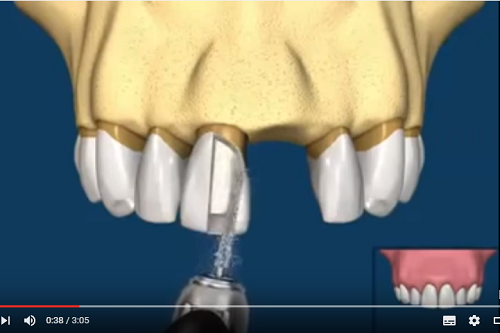 video so sánh cấy ghép implant và cầu răng sứ