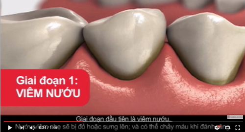 video tổng hợp kiến thức về bệnh nướu
