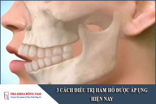 3 cách điều trị hàm hô được áp dụng hiện nay