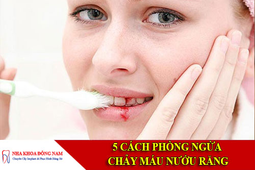 5 cách phòng ngừa chảy máu nướu răng