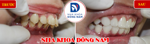 Bọc răng sứ cho răng bị hô 3