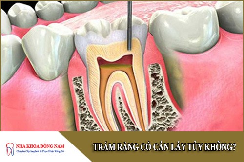trám răng có cần lấy tủy không
