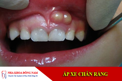 ap xe chan rang