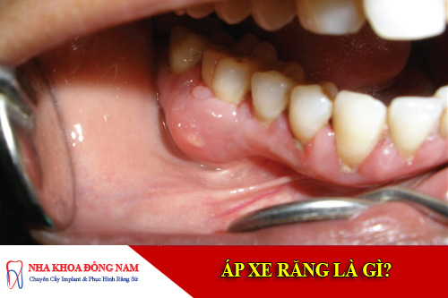ap xe rang la gi