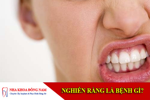 benh nghien rang