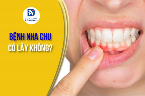 Bệnh nha chu