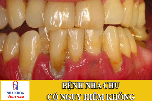 bệnh nha chu có nguy hiểm không?