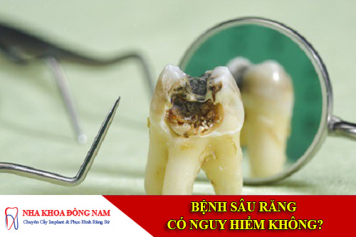 bệnh sâu răng có nguy hiểm không