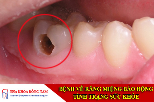 bệnh sâu răng là gì