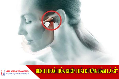 bệnh thoái hóa khớp thái dương hàm là gì?